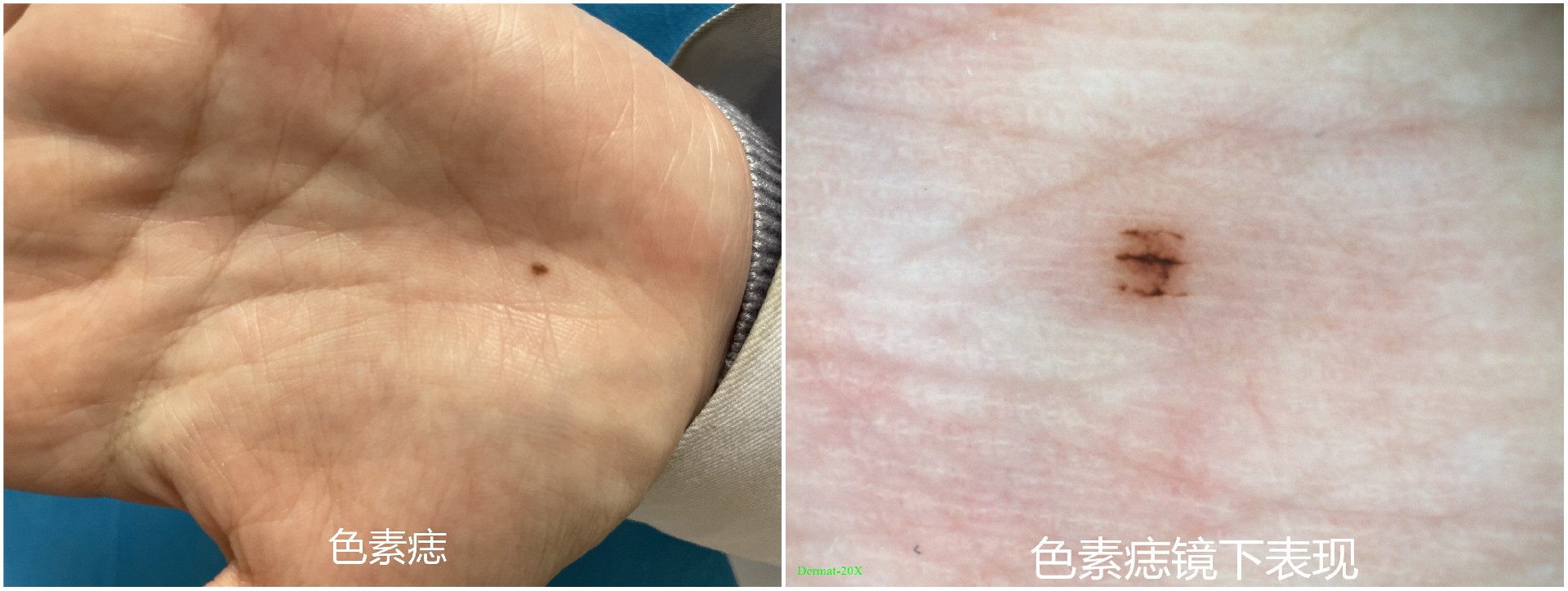 电子皮肤镜有什么用东平县第一人民医院皮肤科开展电子皮肤镜检查惠民活动_https://www.jmylbn.com_新闻资讯_第2张