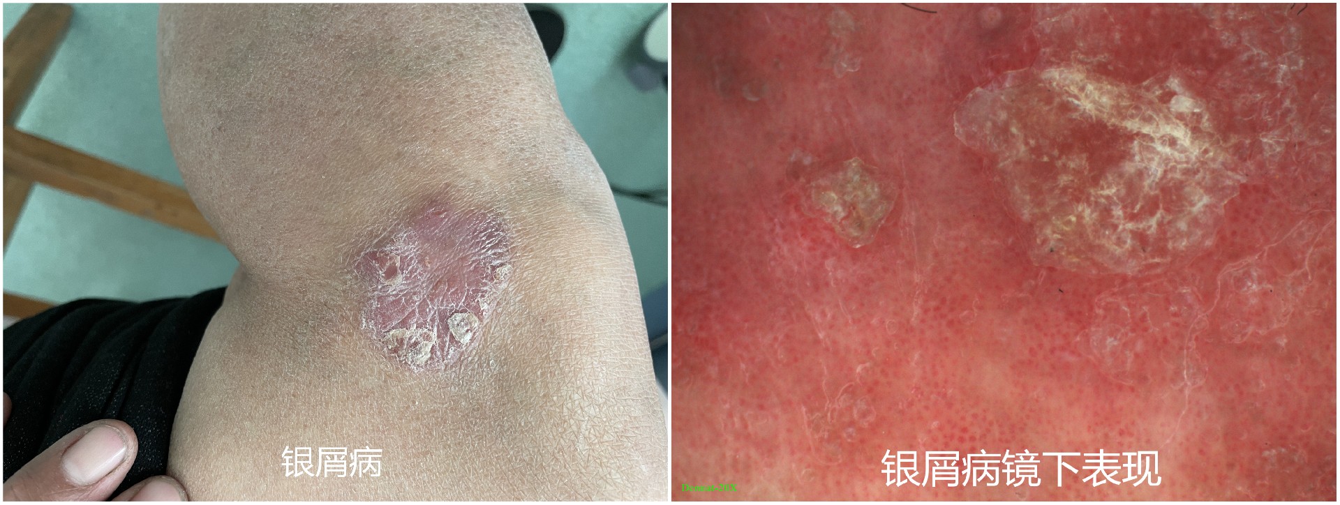 电子皮肤镜有什么用东平县第一人民医院皮肤科开展电子皮肤镜检查惠民活动_https://www.jmylbn.com_新闻资讯_第3张