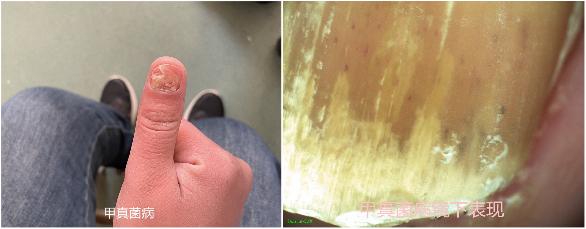 电子皮肤镜有什么用东平县第一人民医院皮肤科开展电子皮肤镜检查惠民活动_https://www.jmylbn.com_新闻资讯_第5张