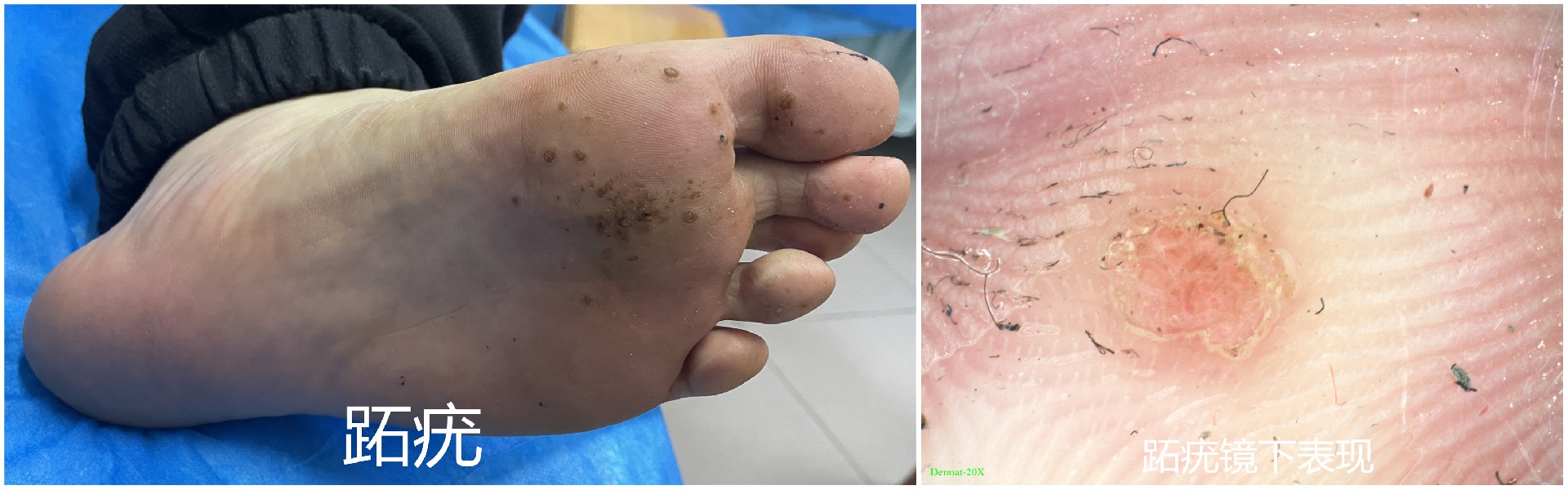 电子皮肤镜有什么用东平县第一人民医院皮肤科开展电子皮肤镜检查惠民活动_https://www.jmylbn.com_新闻资讯_第7张