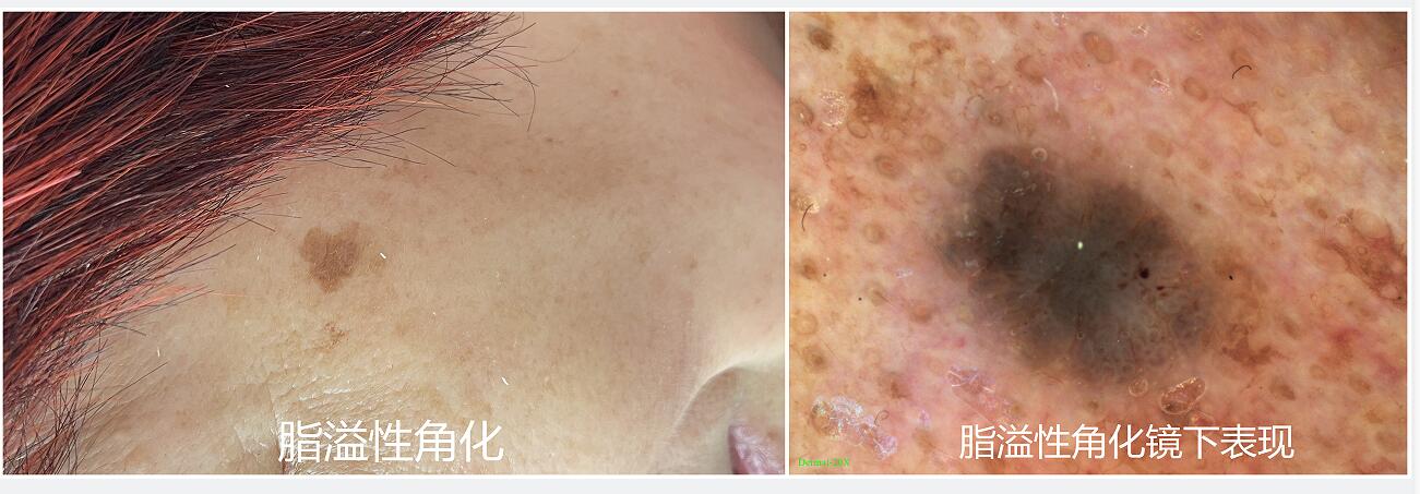 电子皮肤镜有什么用东平县第一人民医院皮肤科开展电子皮肤镜检查惠民活动_https://www.jmylbn.com_新闻资讯_第4张